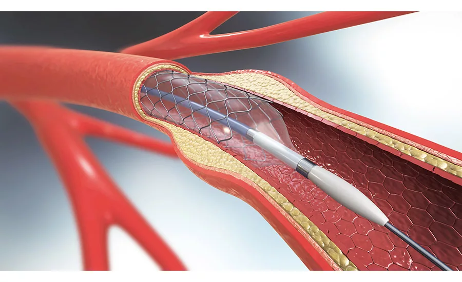 Balloon catheter in situ