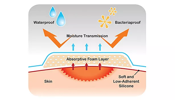 Soft Silicone Adhesives Crucial for Atraumatic Advanced Wound Care Dressings